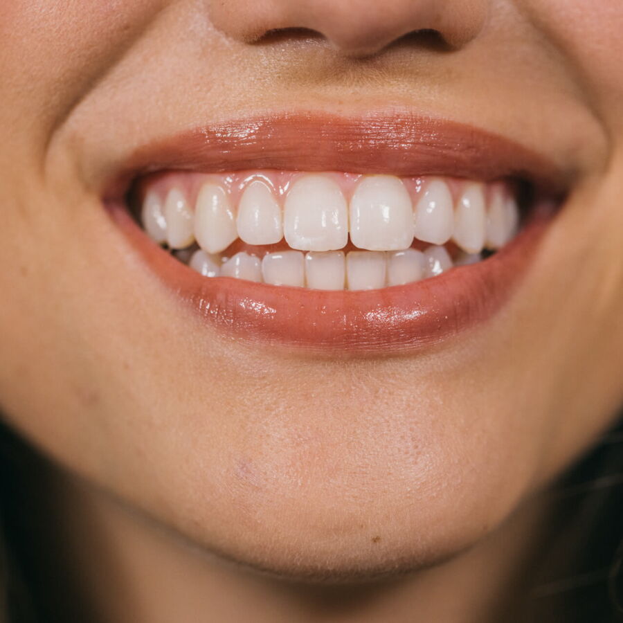 Einfach Pflegen der Zähne und der Aligner-Schiene